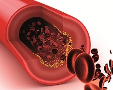 Cholesterol and TCM